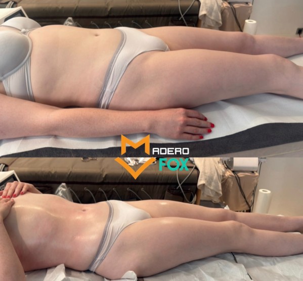 Lymphatic body sculpting result 4